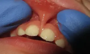 Close-up of a baby's mouth showing a lip tie. The frenulum is visible, and the baby's teeth are present. This condition can affect pacifier use.