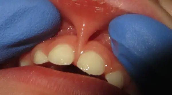 Close-up of a baby's mouth showing a lip tie. The frenulum is visible, and the baby's teeth are present. This condition can affect pacifier use.