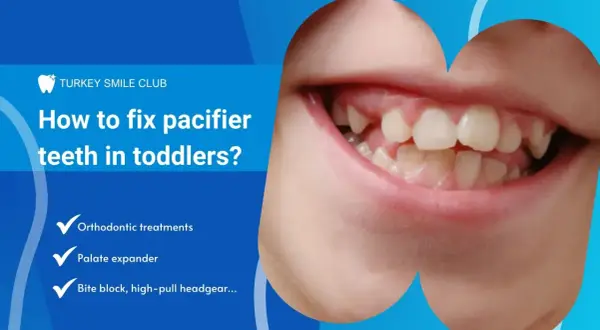 Close-up of a toddler's mouth showing misaligned teeth, likely due to pacifier use. Text discusses fixing pacifier teeth with orthodontic treatments.