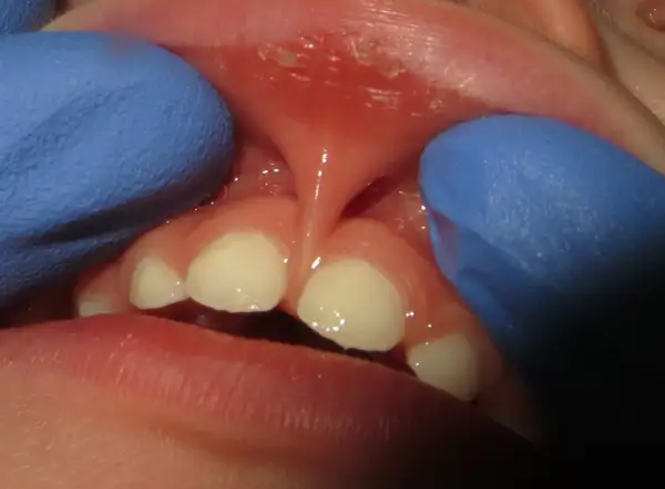 Close-up of a baby's mouth showing a lip tie. The frenulum is visible, and the baby's teeth are present. This condition can affect pacifier use.