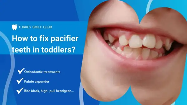 Close-up of a toddler's mouth showing misaligned teeth, likely due to pacifier use. Text discusses fixing pacifier teeth with orthodontic treatments.